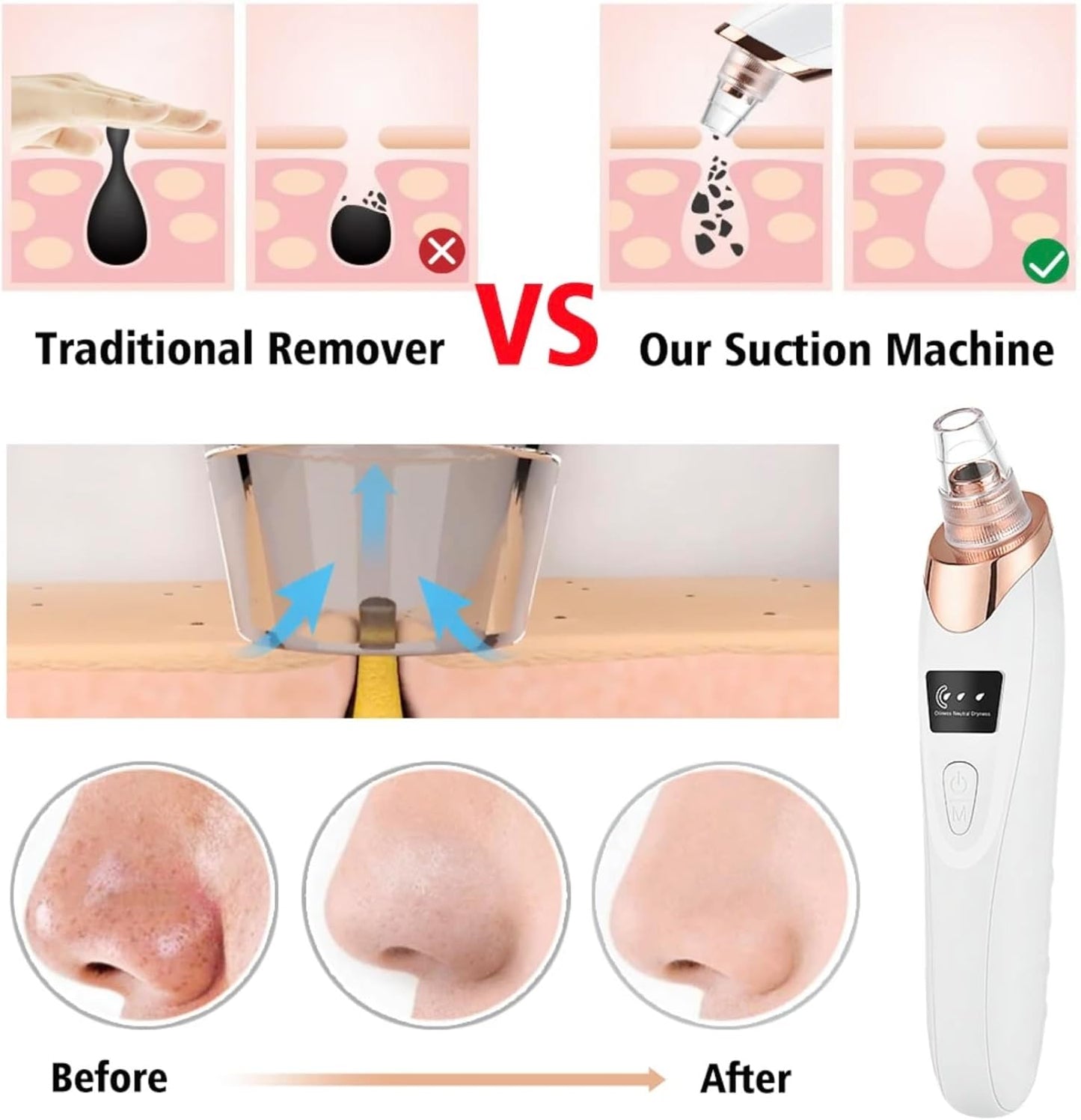 2024 Newest Blackhead Remover Pore Vacuum,Facial Pore Cleaner-5 Suction Power,5 Probes,Usb Rechargeable Blackhead Vacuum Kit Electric Acne Extractor Tool for Women