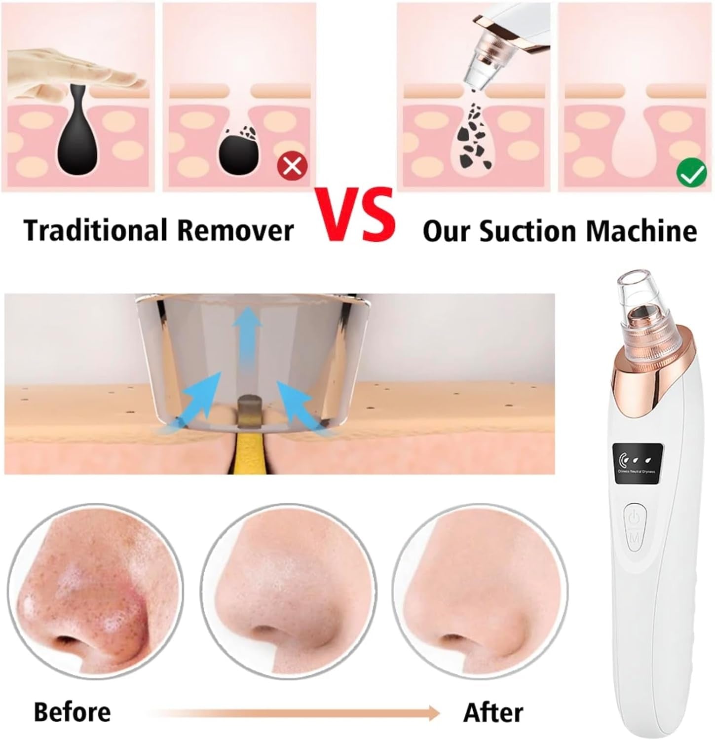2024 Newest Blackhead Remover Pore Vacuum,Facial Pore Cleaner-5 Suction Power,5 Probes,Usb Rechargeable Blackhead Vacuum Kit Electric Acne Extractor Tool for Women